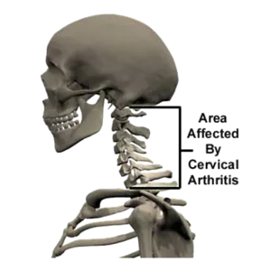 liberazione zona cervicale